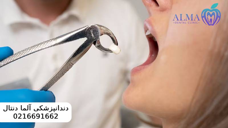 کشیدن ریشه دندان عفونی