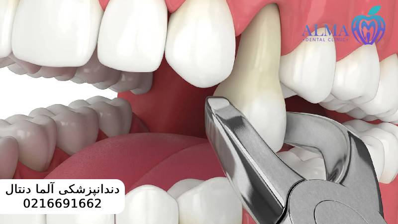 کشیدن ریشه دندان عفونی