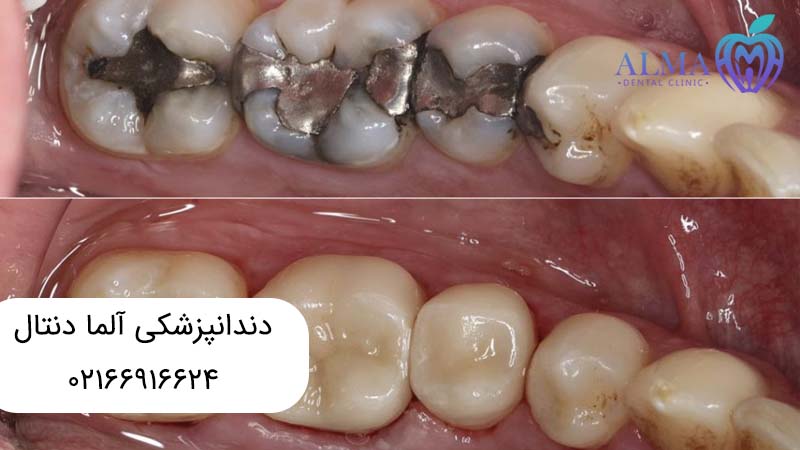 تفاوت ترمیم دندان با عصب کشی