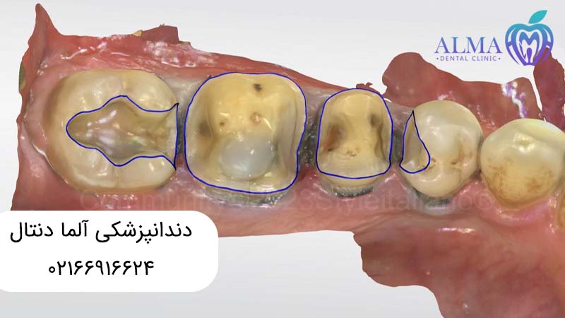 تفاوت ترمیم دندان با عصب کشی