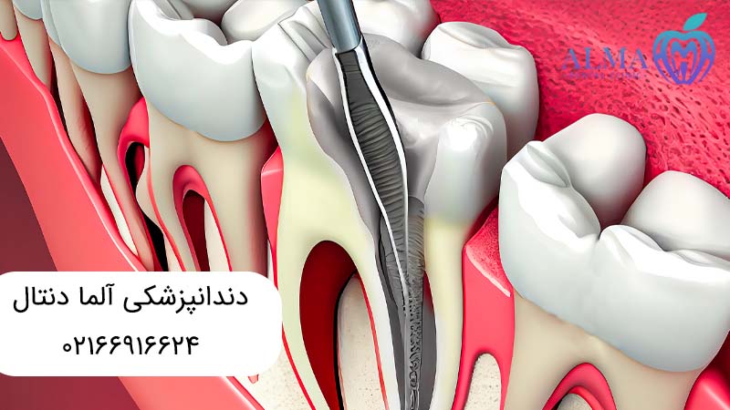 فرق درمان ریشه با عصب کشی