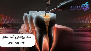 درمان ریشه بدون عصب کشی