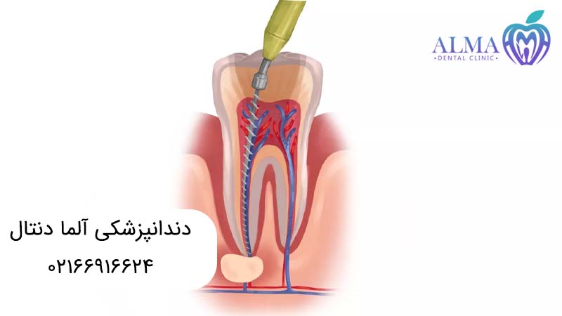 فرق درمان ریشه با عصب کشی