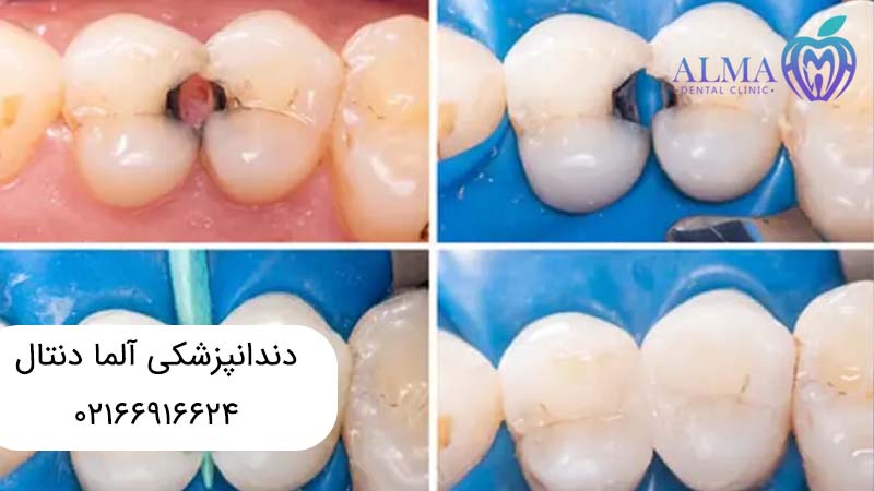 تفاوت ترمیم دندان با عصب کشی