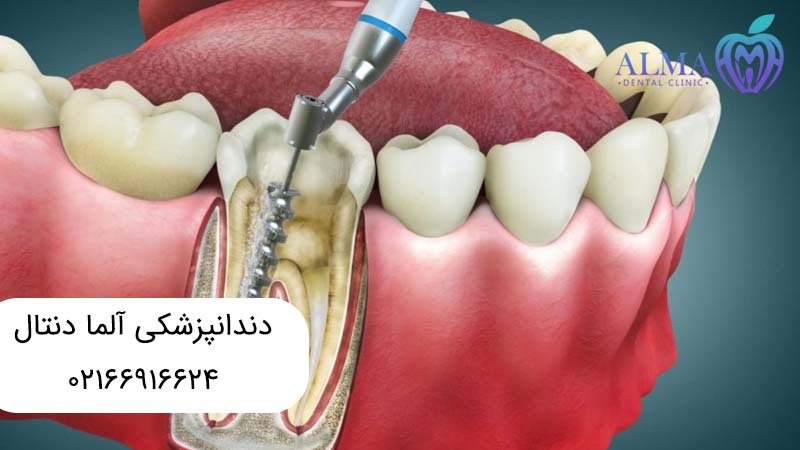 فرق درمان ریشه با عصب کشی