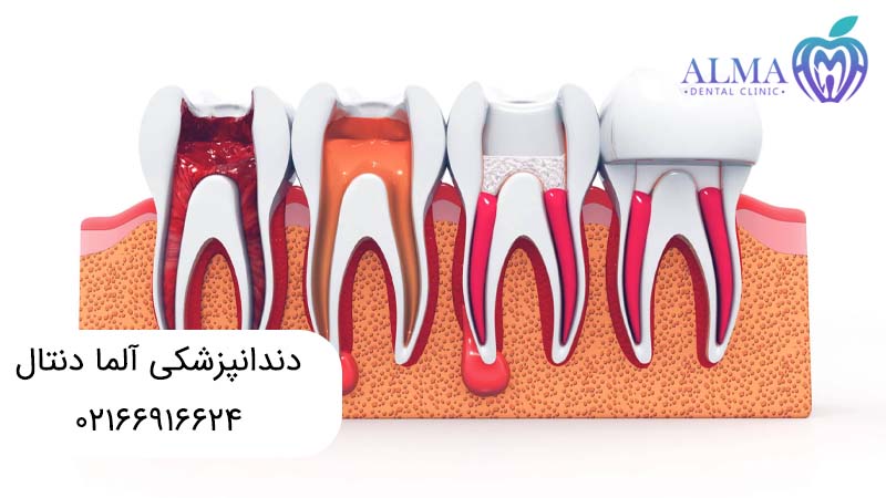 درمان ریشه بدون عصب کشی