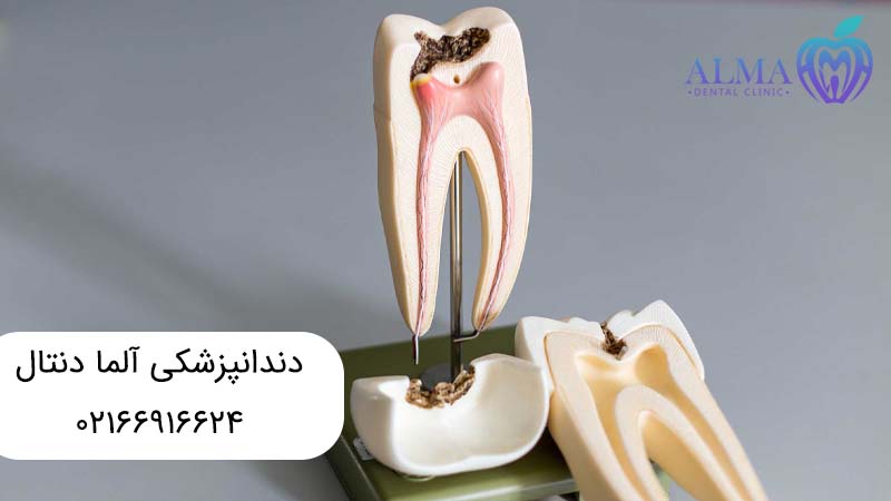 تفاوت ترمیم دندان با عصب کشی