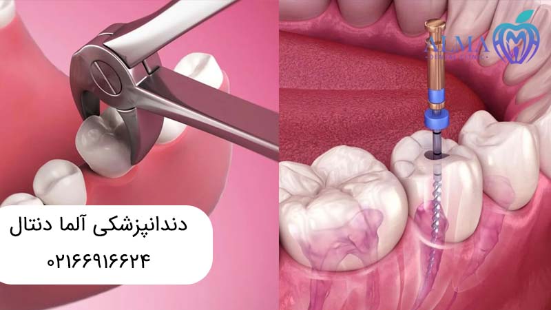 فرق درمان ریشه با عصب کشی