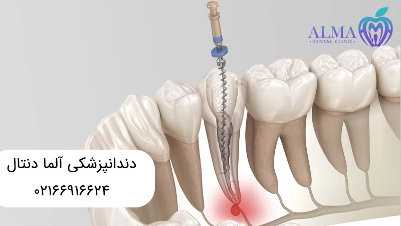 درمان ریشه بدون عصب کشی