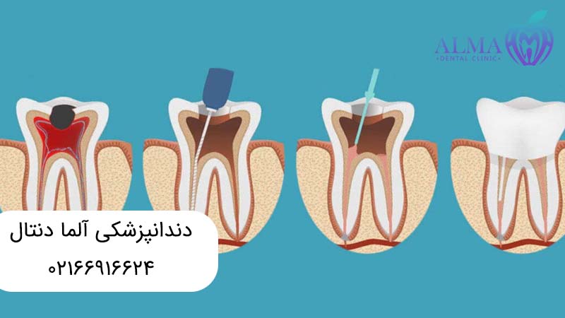 تفاوت ترمیم دندان با عصب کشی
