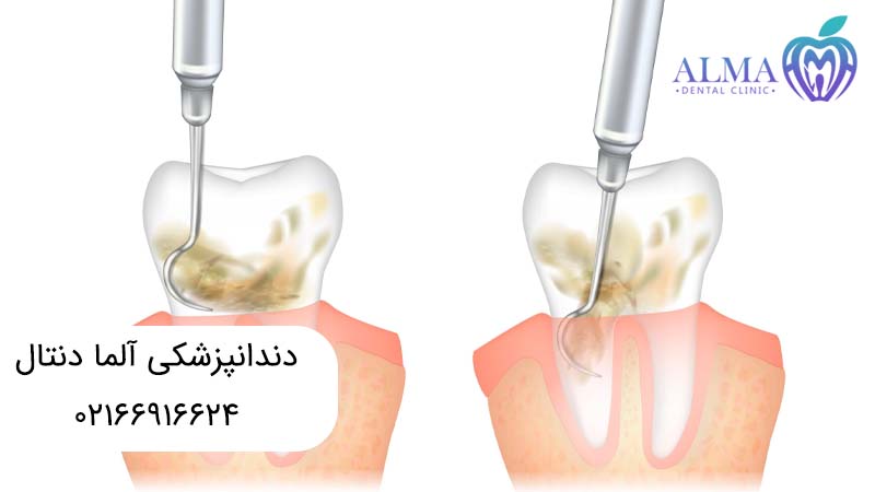 فرق درمان ریشه با عصب کشی
