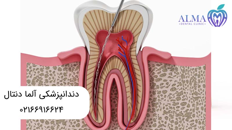 درمان ریشه بدون عصب کشی