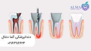 تفاوت ترمیم دندان با عصب کشی