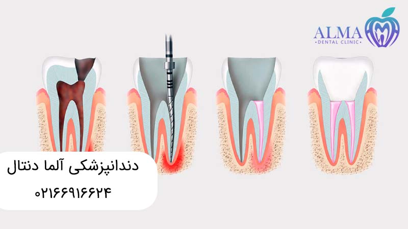 تفاوت ترمیم دندان با عصب کشی