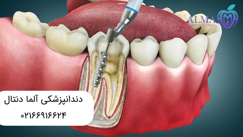 درمان ریشه بدون عصب کشی