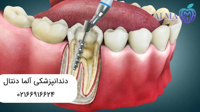 تفاوت ترمیم دندان با عصب کشی