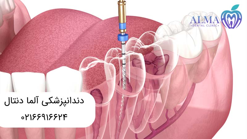 درمان ریشه بدون عصب کشی