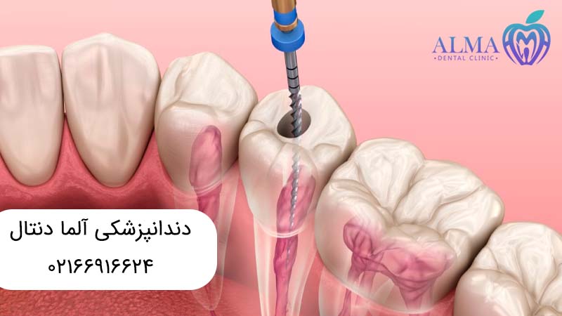 درمان ریشه بدون عصب کشی