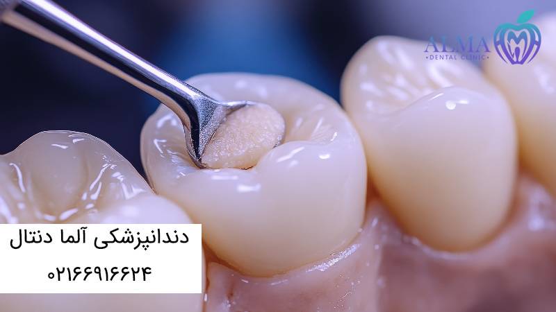 درد بعد از عصب کشی و پر کردن دندان