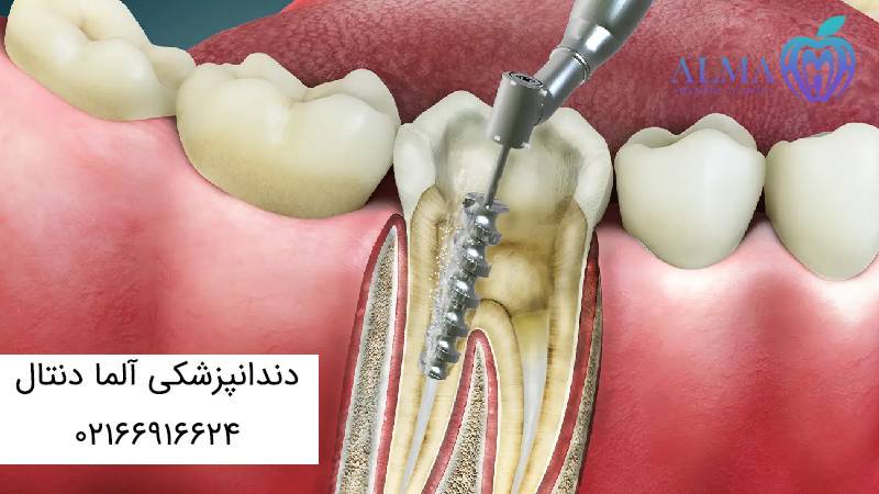 درد بعد از عصب کشی و پر کردن دندان