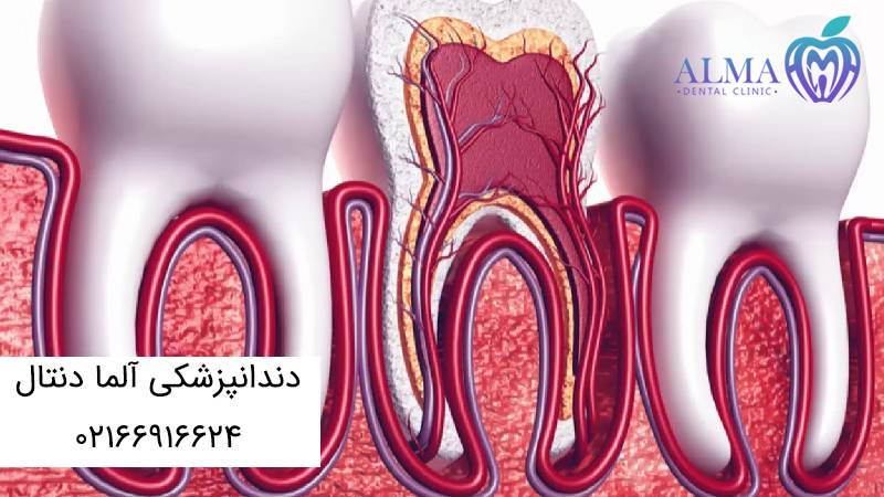 درد بعد از عصب کشی و پر کردن دندان