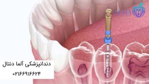 درد بعد از عصب کشی و پر کردن دندان