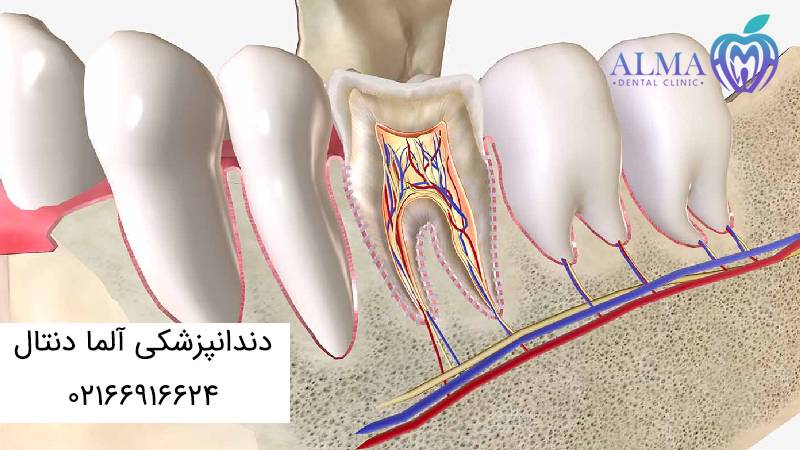 درد بعد از عصب کشی و پر کردن دندان