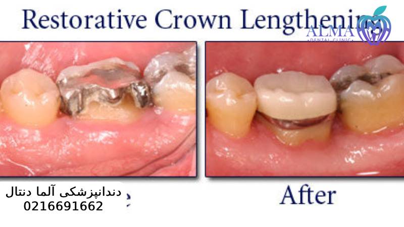 جراحی سی ال لثه