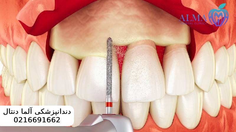 جراحی سی ال لثه