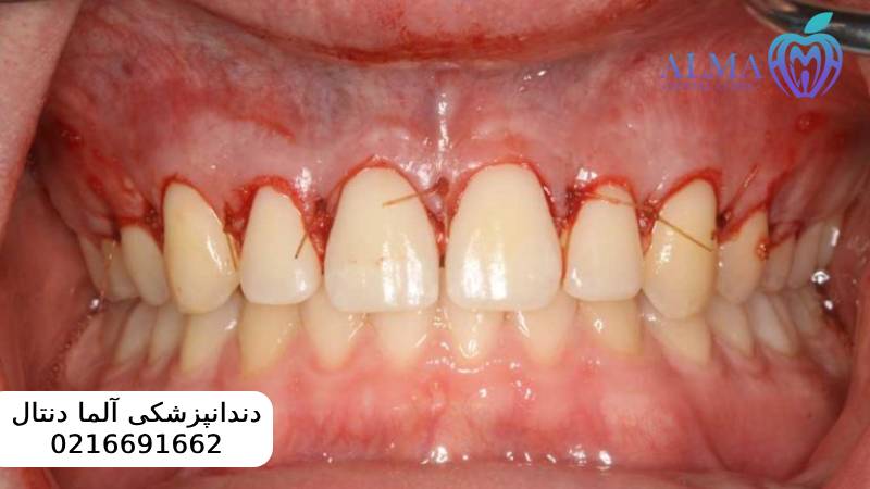 جراحی سی ال لثه