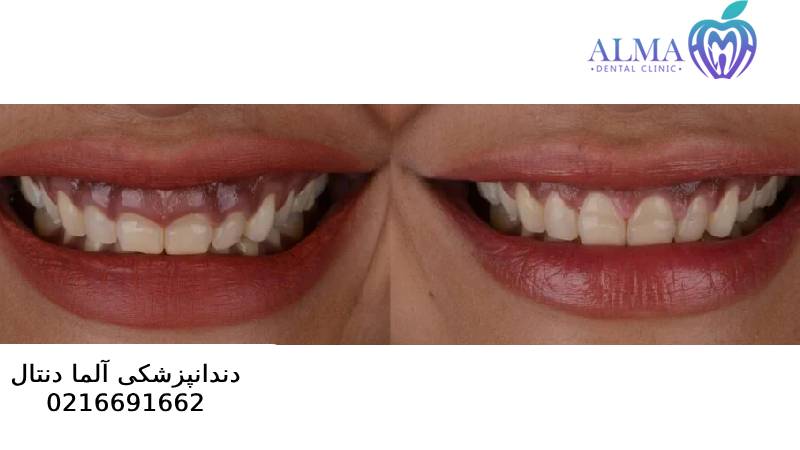 جراحی سی ال لثه