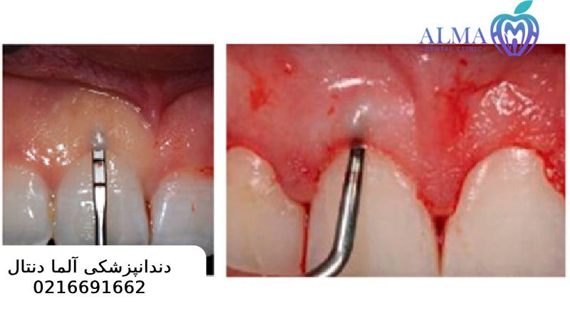 جراحی سی ال لثه