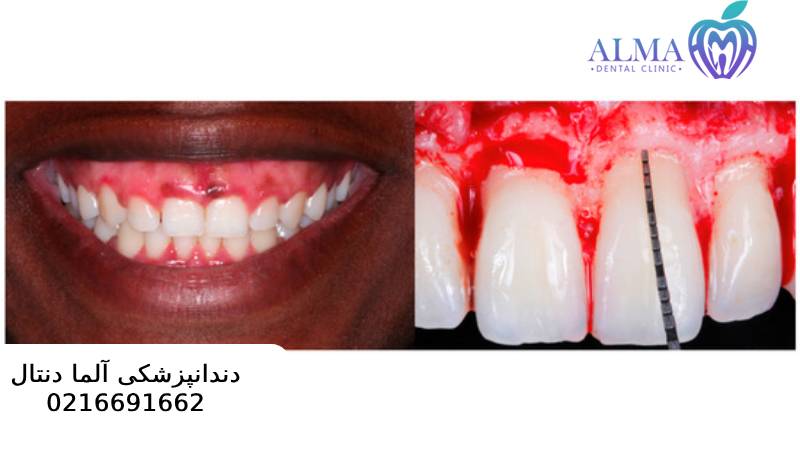 جراحی سی ال لثه