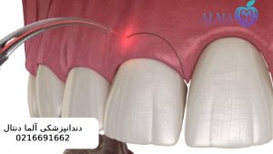 جراحی سی ال لثه