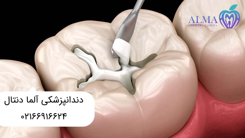 بهترین مواد برای پر کردن دندان