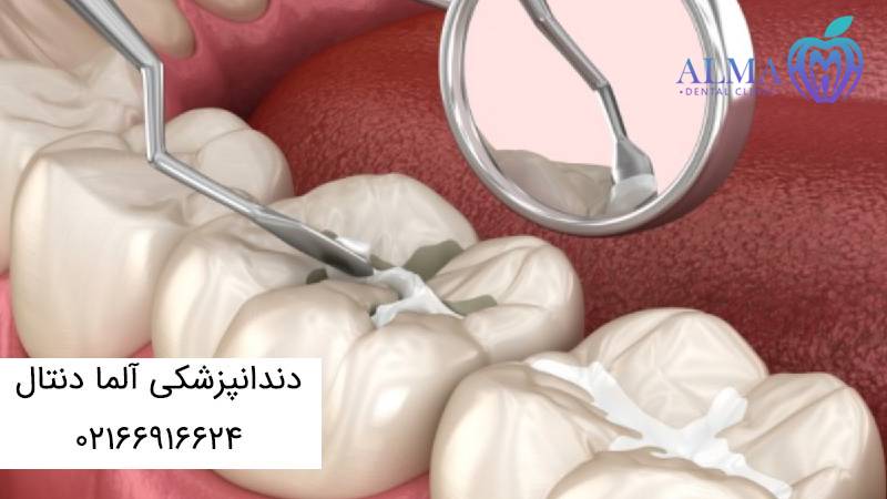 درد بعد از عصب کشی و پر کردن دندان