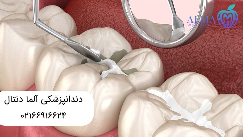 بهترین مواد برای پر کردن دندان