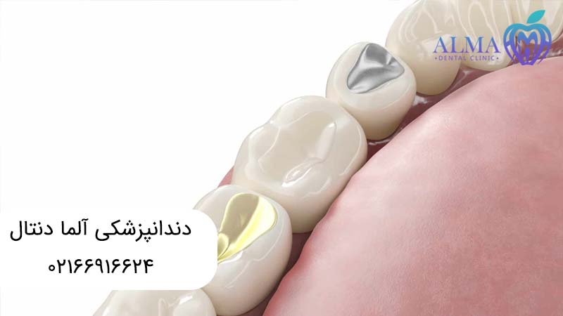 بهترین مواد برای پر کردن دندان