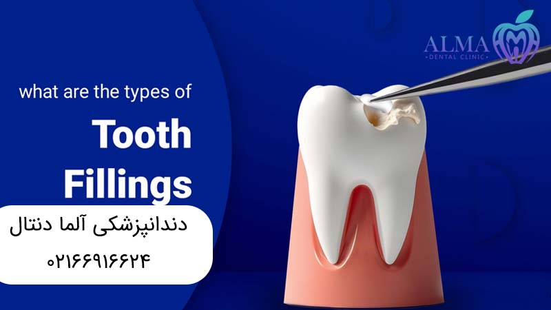 بهترین مواد برای پر کردن دندان