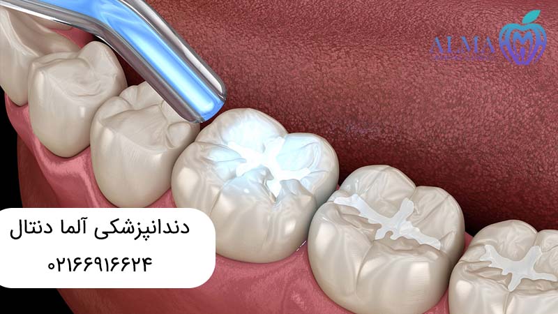 بهترین مواد برای پر کردن دندان