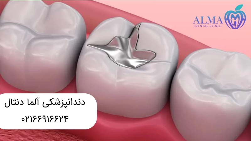 بهترین مواد برای پر کردن دندان