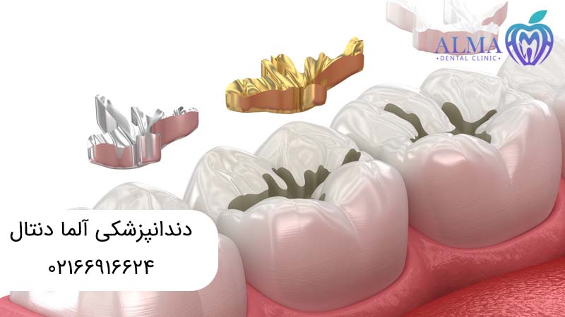 بهترین مواد برای پر کردن دندان