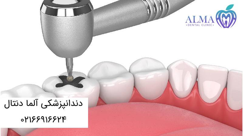 درد بعد از عصب کشی و پر کردن دندان