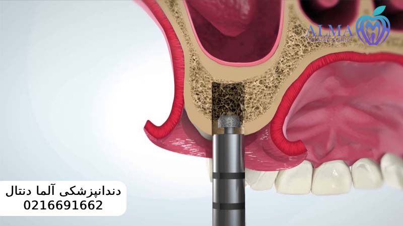 جراحی سینوس لیفت برای ایمپلنت