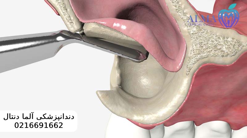 جراحی سینوس لیفت برای ایمپلنت