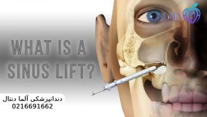 جراحی سینوس لیفت برای ایمپلنت