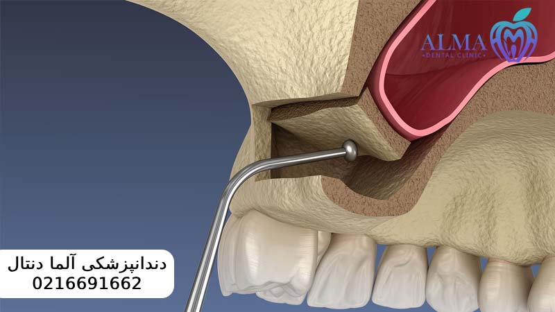 جراحی سینوس لیفت برای ایمپلنت