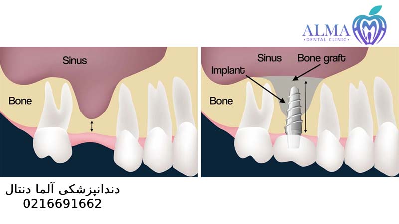 جراحی سینوس لیفت برای ایمپلنت